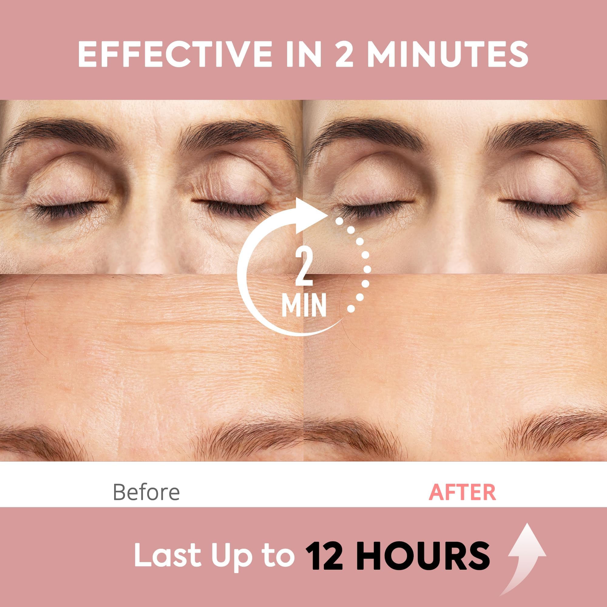 St. Mege wrinkle-smile-lines before-after focus on smoother skin.