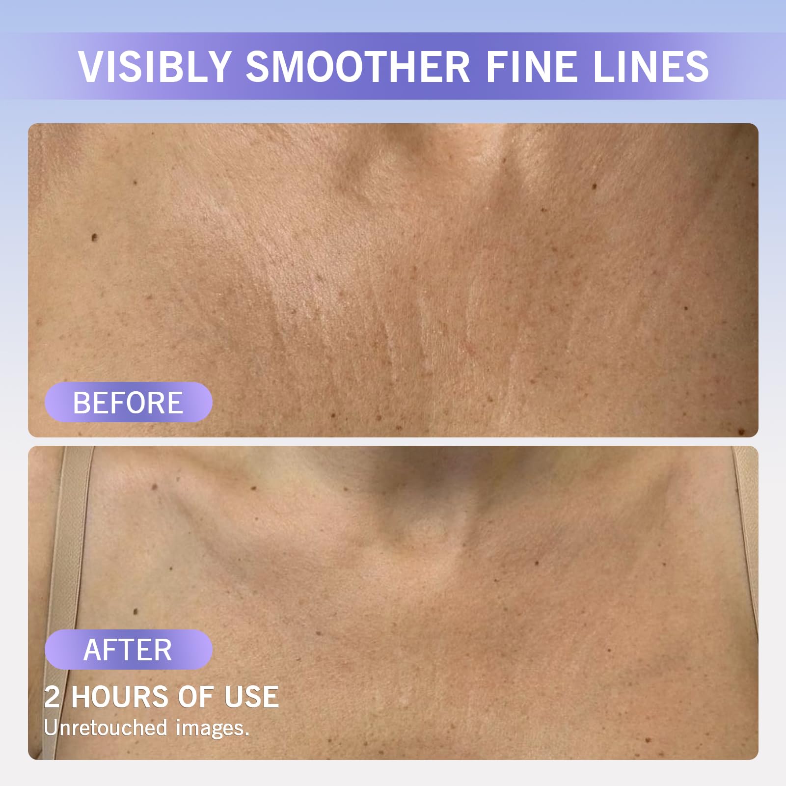 Stasover face wrinkle patches help reduce visible lines while you relax.