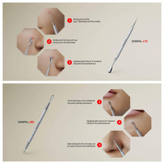 Suvorna milia remover tool closeup for safe milia extraction