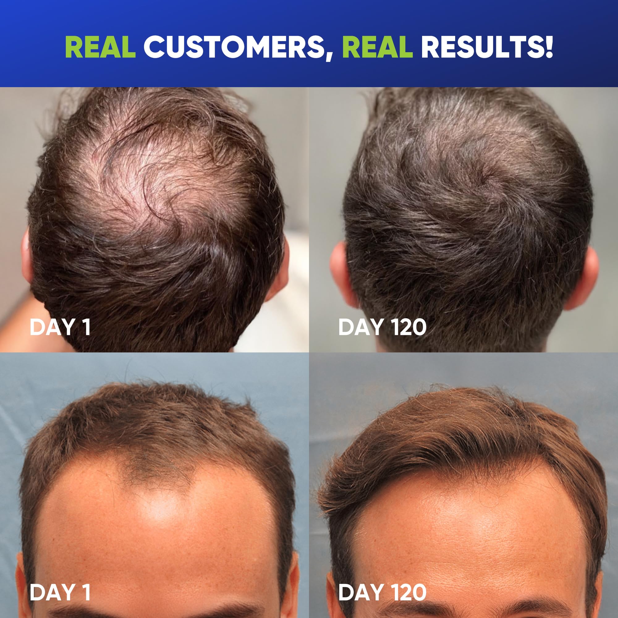 Svvimer rosemary tea tree oil image emphasizes refreshing scalp care with natural oils