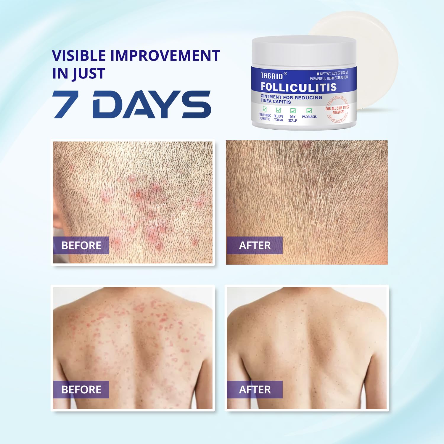 TAGRID Folliculitis Cream dispensing pump illustrates easy, mess-free use.