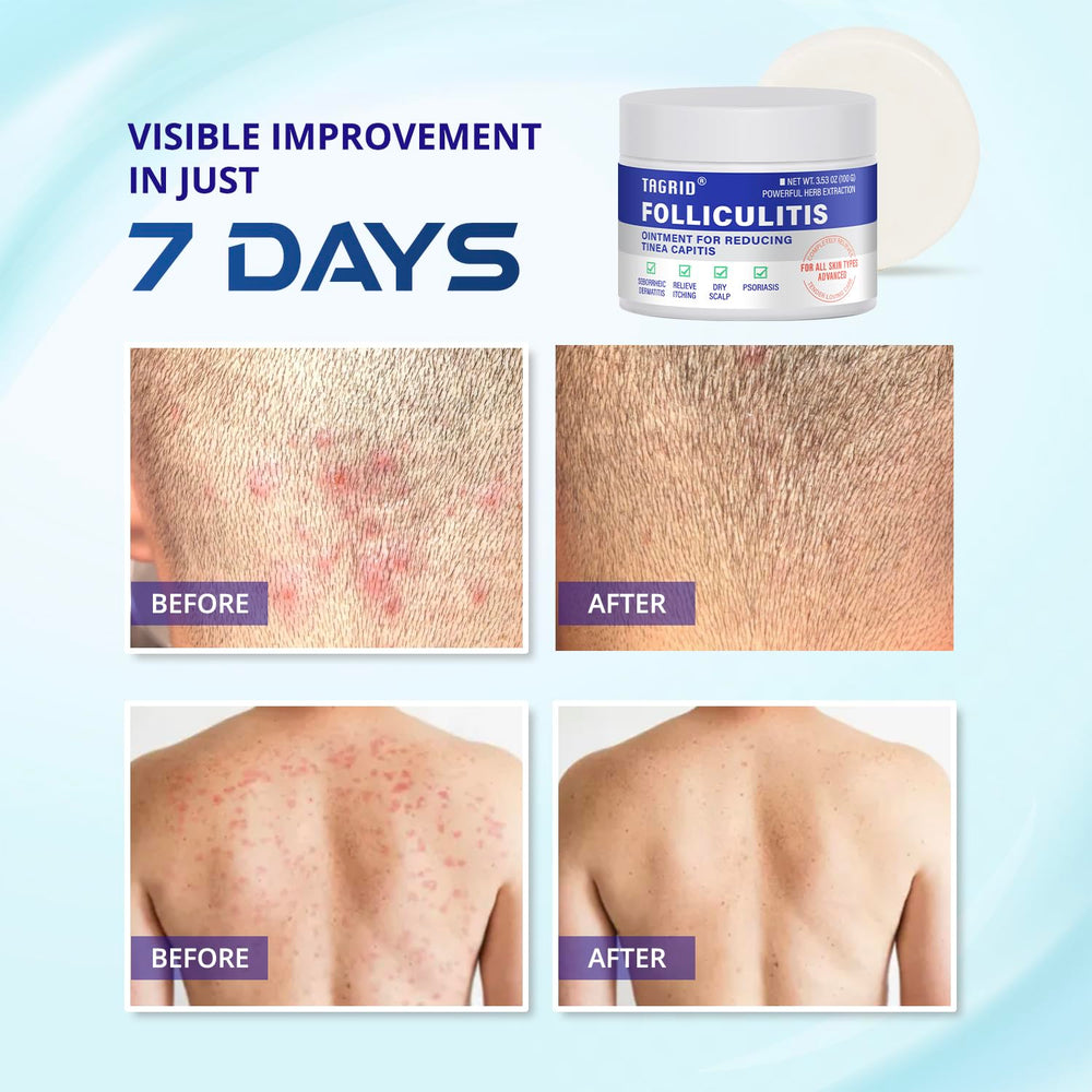 TAGRID Folliculitis Cream dispensing pump illustrates easy, mess-free use.