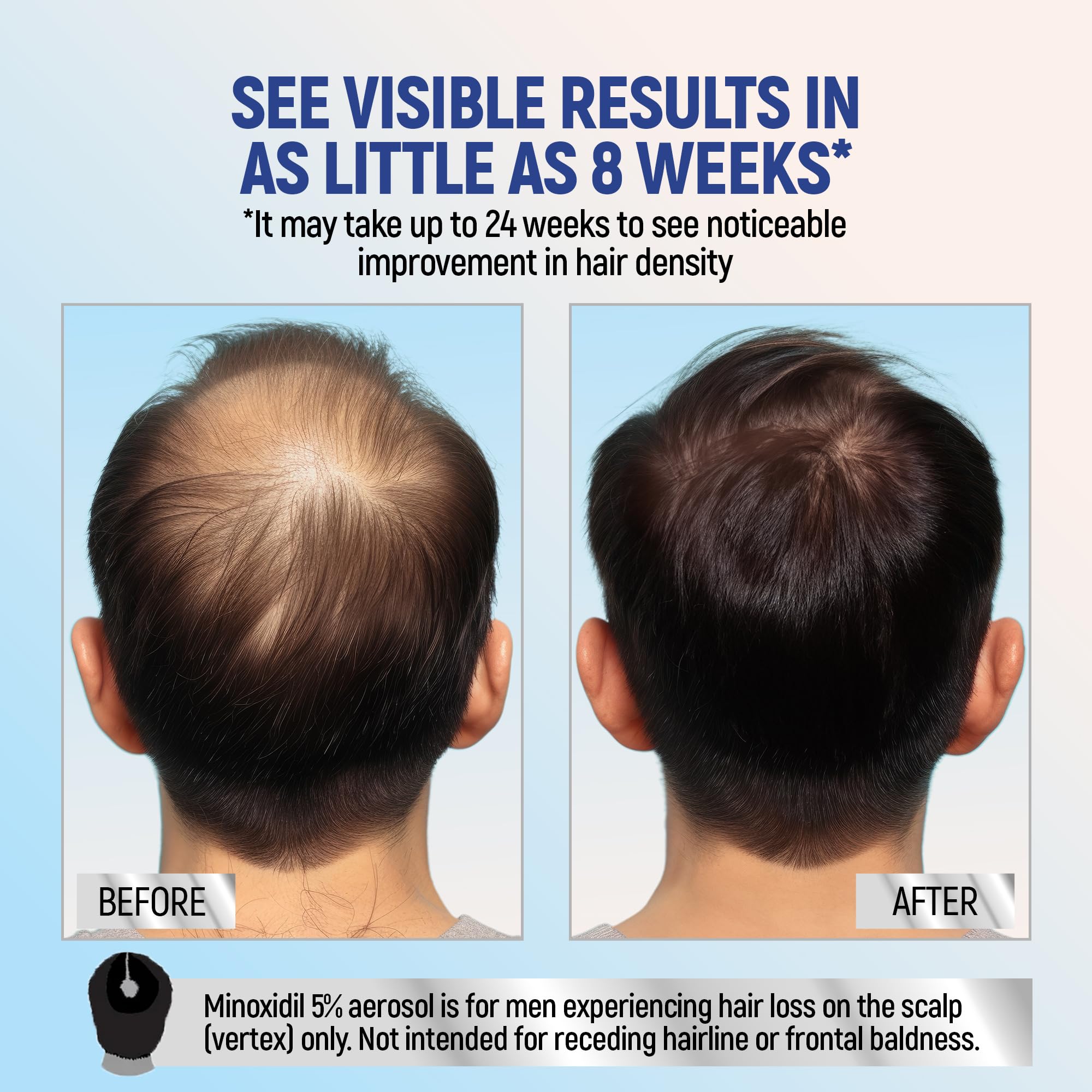 TARO Minoxidil 4-pack packaging showing a four-month supply for men.