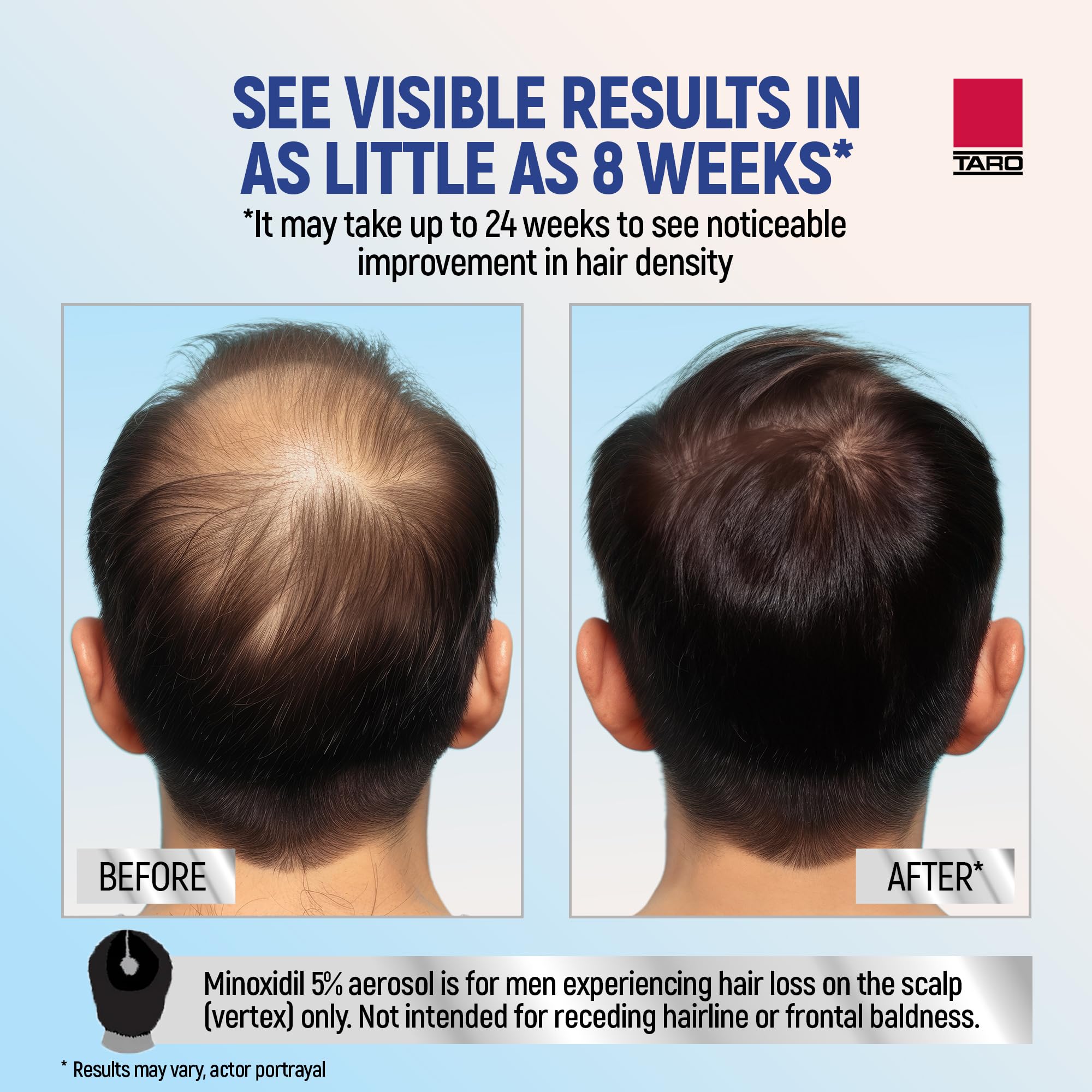 TARO Minoxidil foam applied to scalp showing scalp coverage potential.