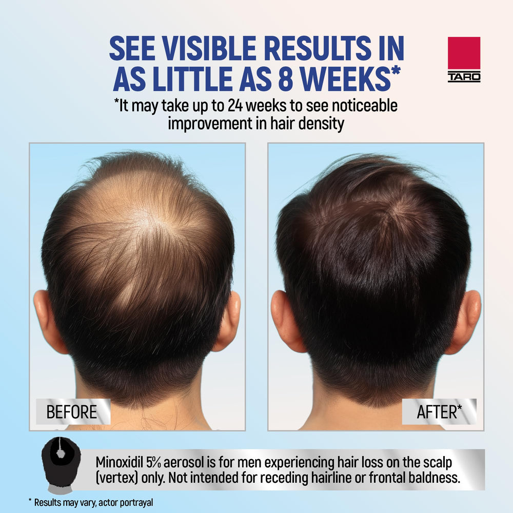 TARO Minoxidil foam applied to scalp showing scalp coverage potential.