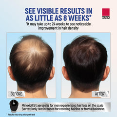TARO Minoxidil foam applied to scalp showing scalp coverage potential.