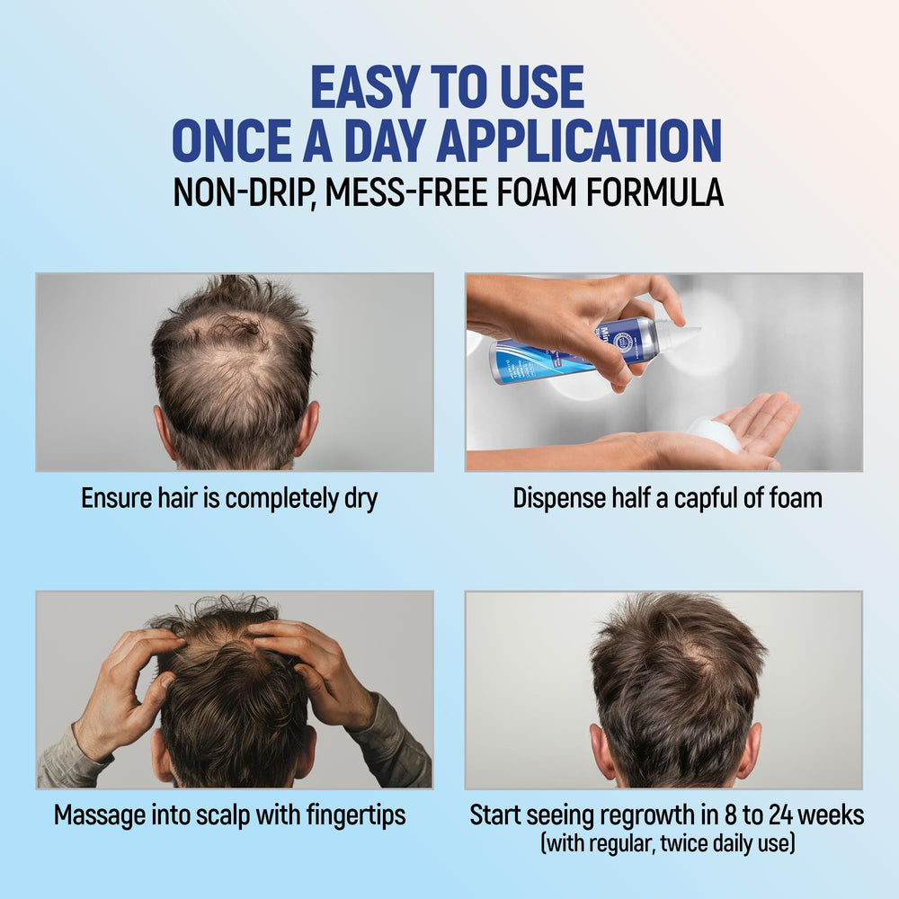 TARO minoxidil foam on scalp shows coverage area.
