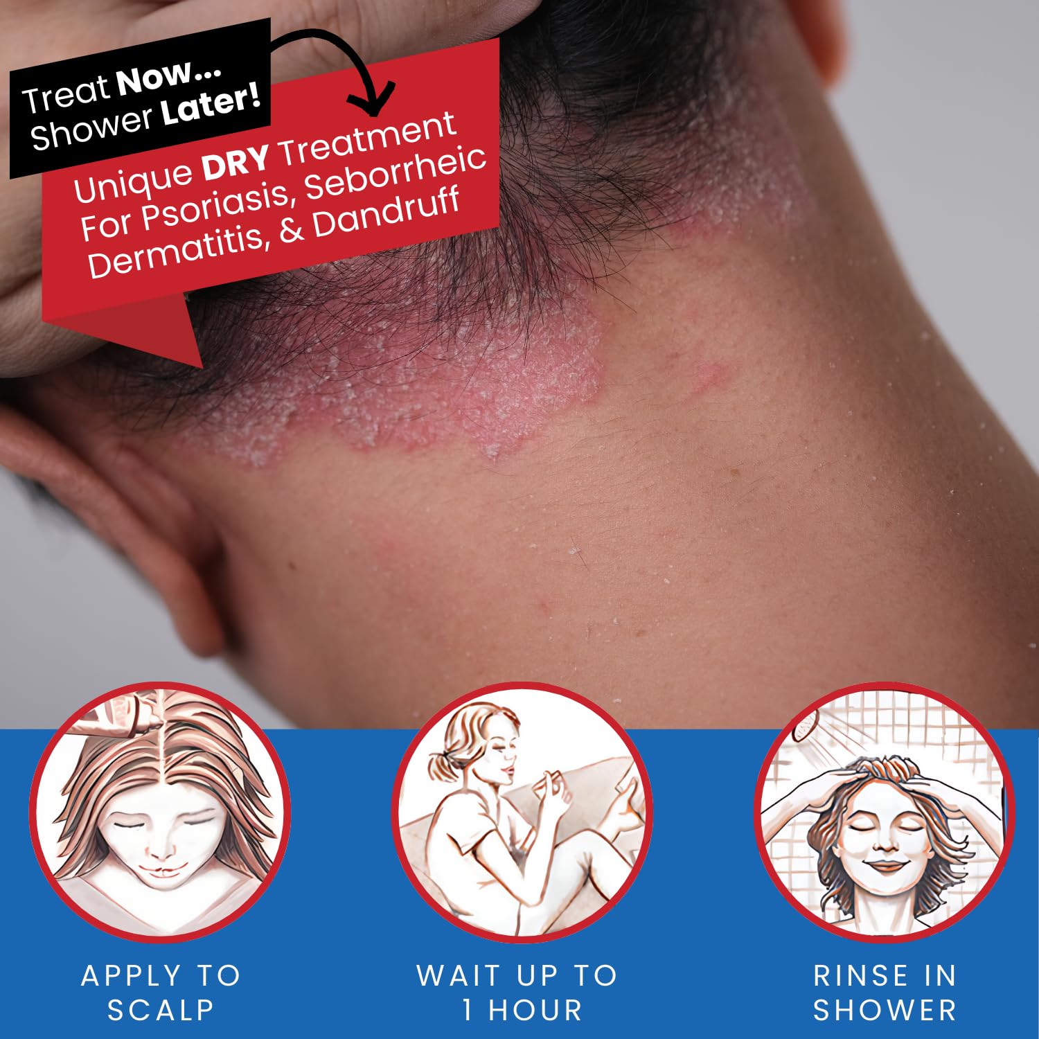 Tarsum shampoo applied to dry scalp for longer contact and relief