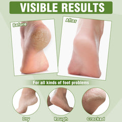 TEAWOO moisturizing socks being applied for easy at-home foot care