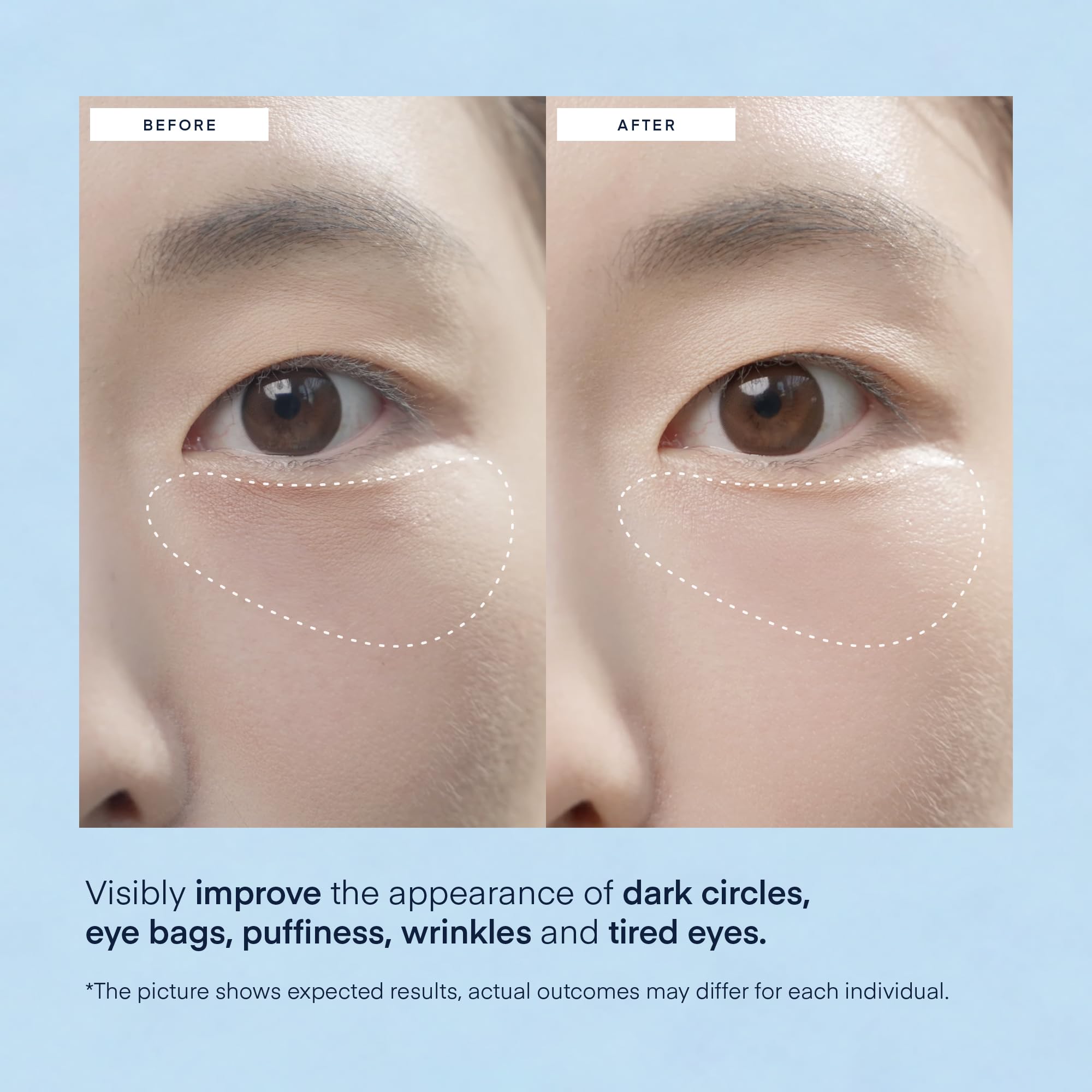 TEREZ & HONOR Under Eye Patches being applied to the under-eye area for soothing hydration.