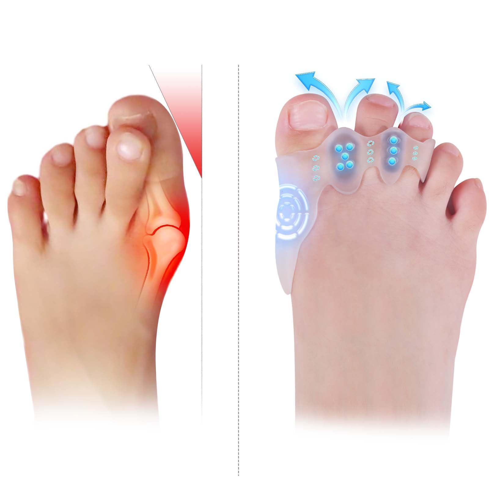 Tevezo toe spacers kids package open showing ready-to-use comfort