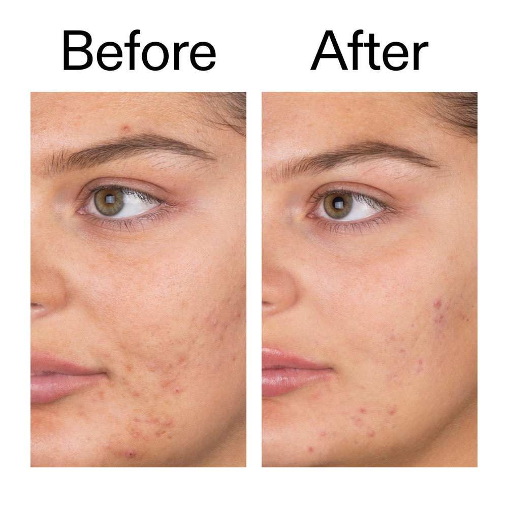 Product on clean surface suggesting budget-friendly routine and accessible skincare