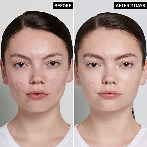 The INKEY List product beside before-and-after blemish comparison.