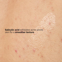 The Ordinary applied to back area showing targeted blemish treatment