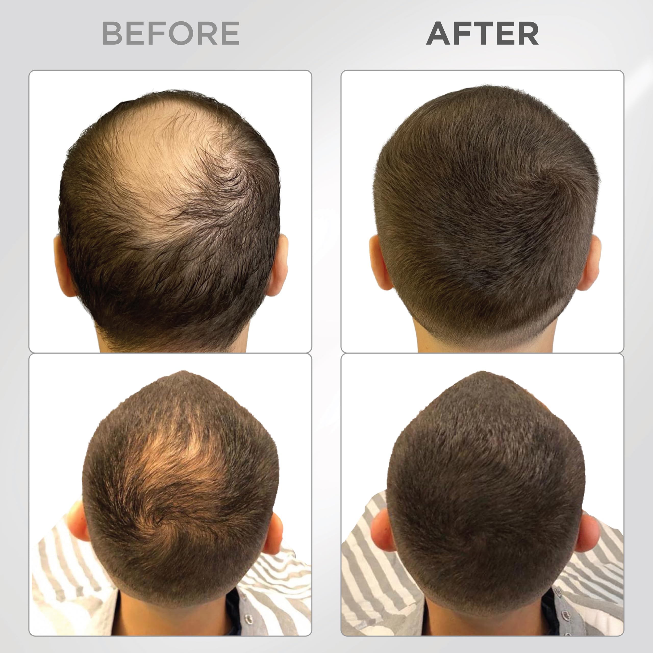Thick Fiber hair fibers applied to dry thinning areas for natural coverage