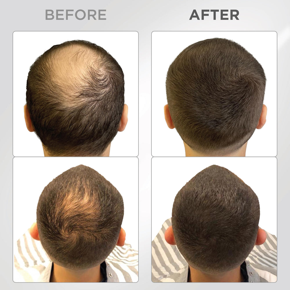 Thick Fiber hair fibers applied to dry thinning areas for natural coverage