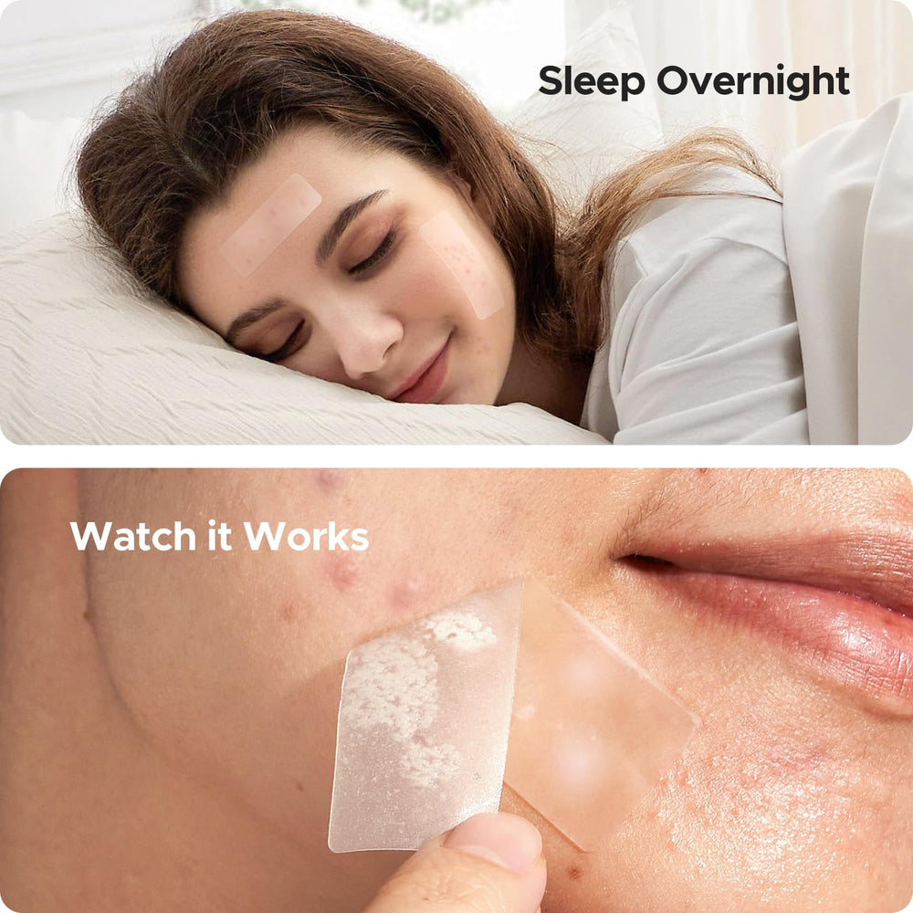 TKTK Large Pimple Patches 12mm patch on skin versatile coverage for small spots.