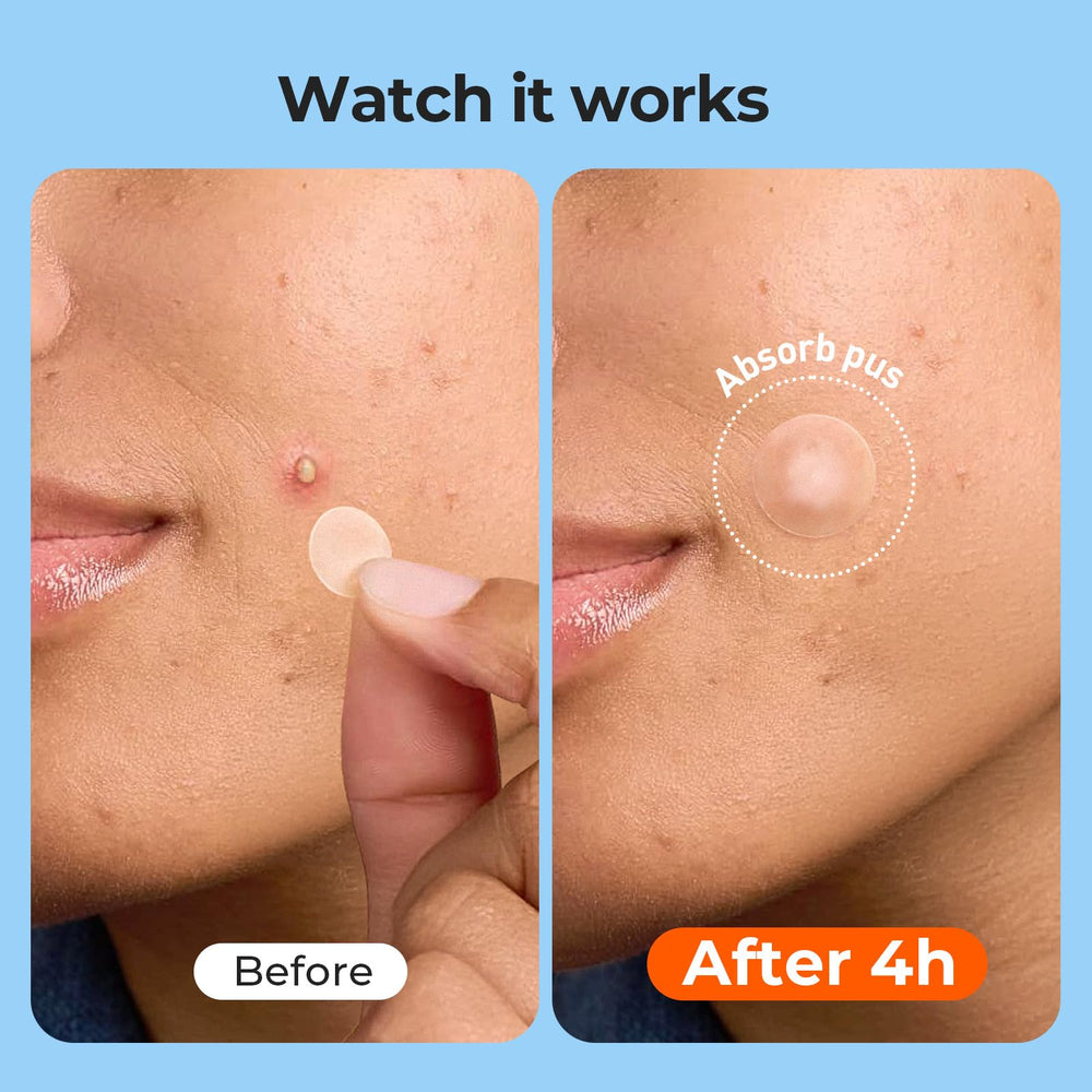 TKTK Pimple Patches back/cheek large patches ideal for back or cheek breakouts.
