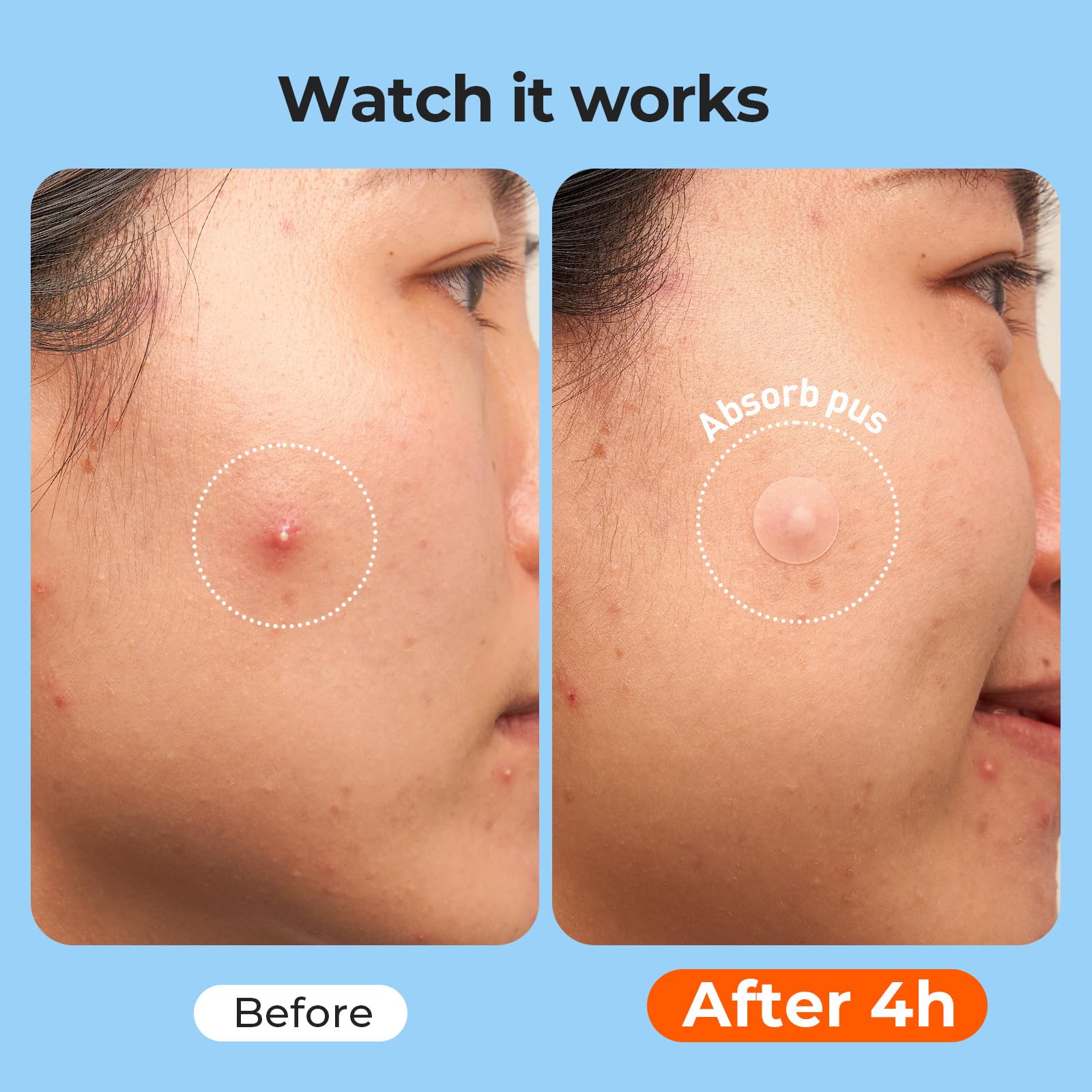 TKTK pimple patches contoured 33x23mm oriented for cheeks and chin areas