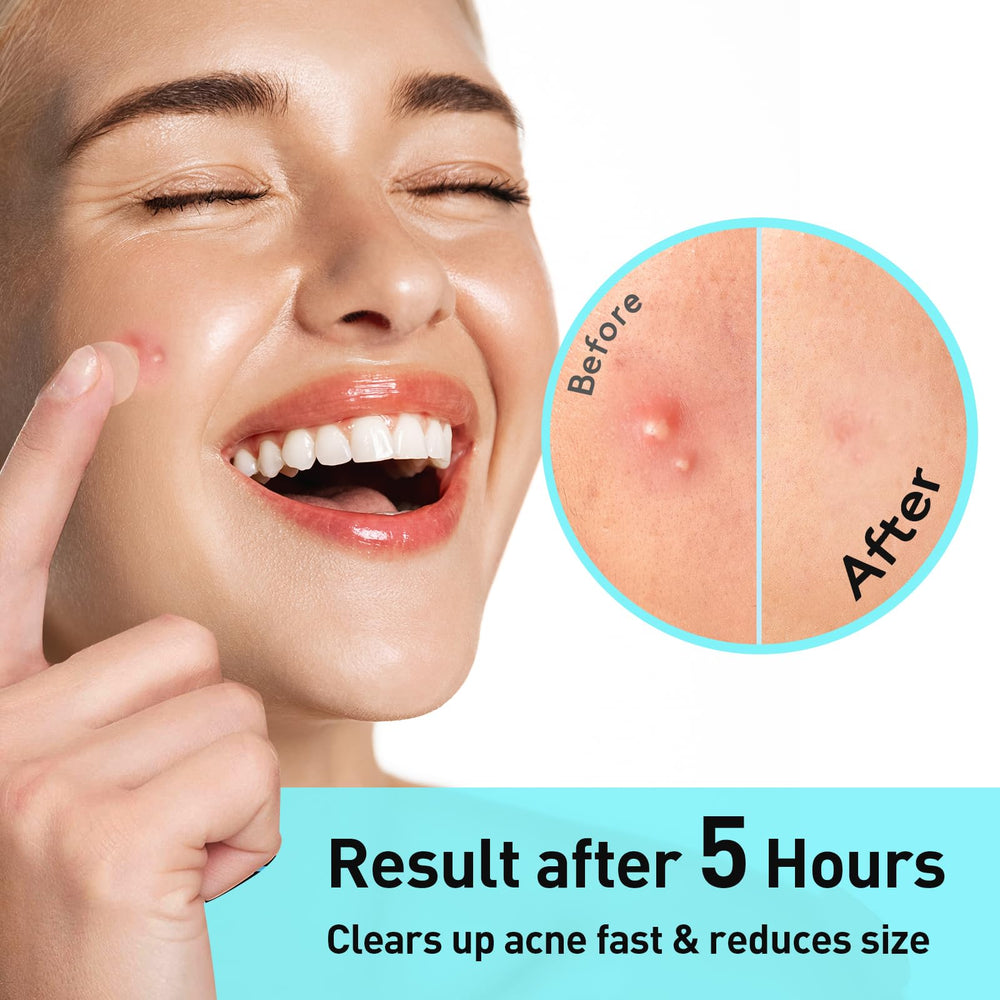TKTK Pimple Patches on face under makeup for discreet daytime use
