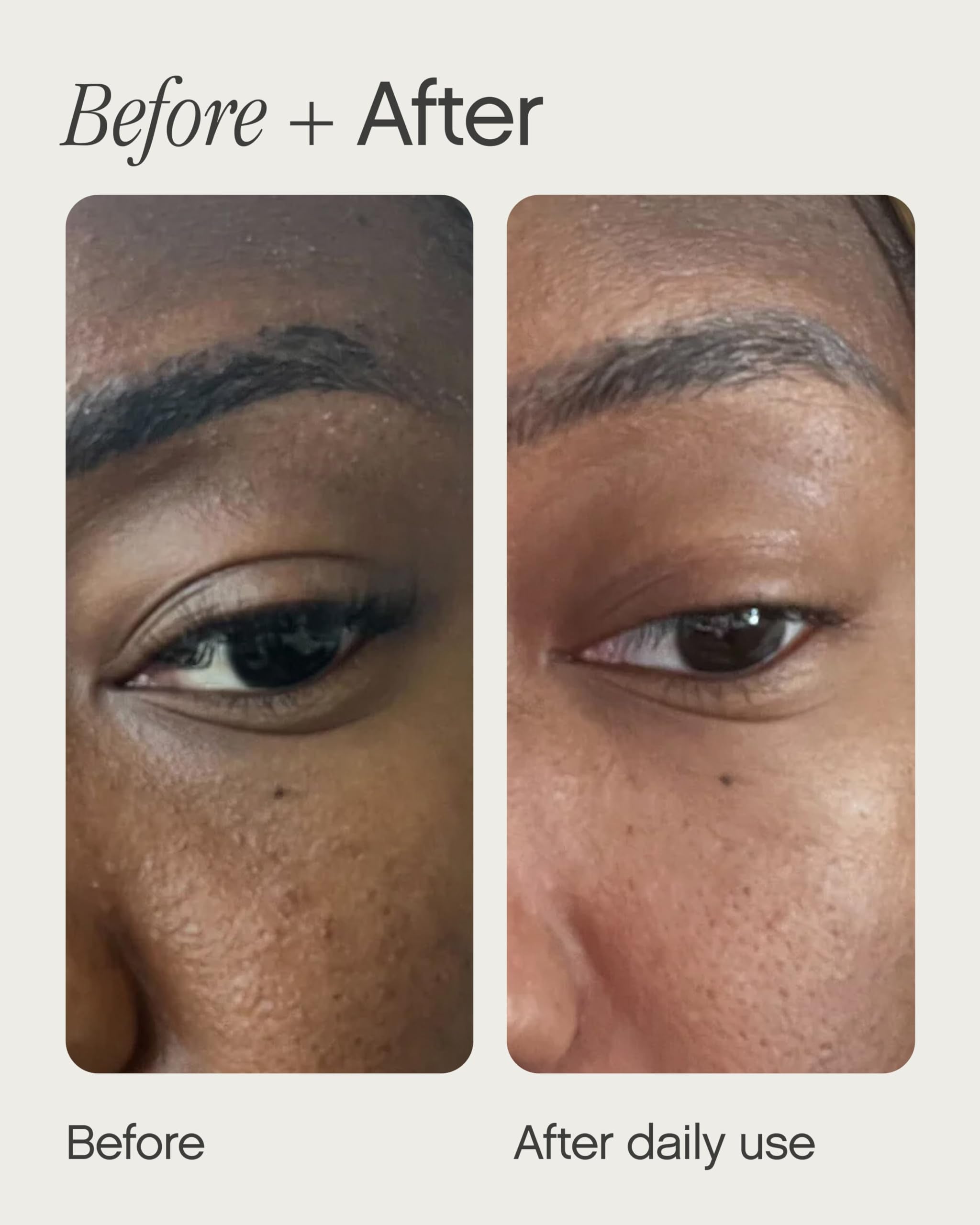 Topicals Sealed on-face view shows retinol and salicylic acid action