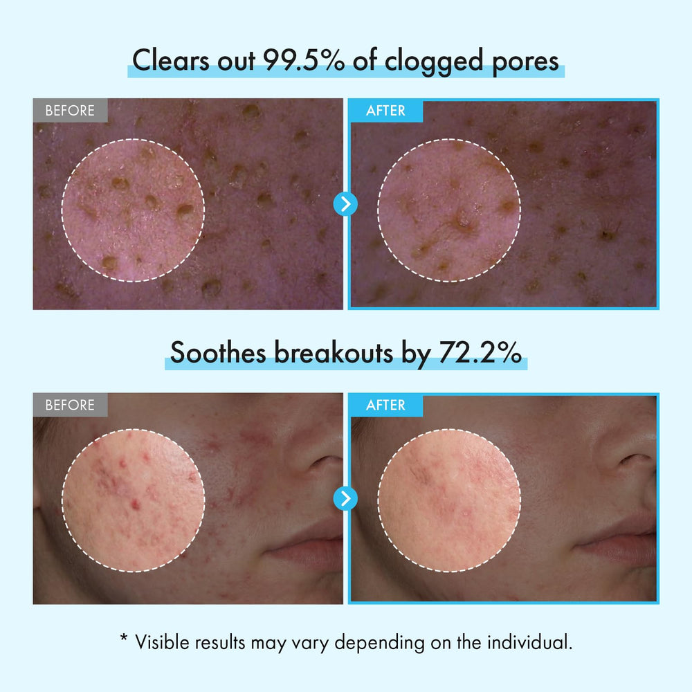TOSOWOONG micro capsules adhering to pores to lift impurities