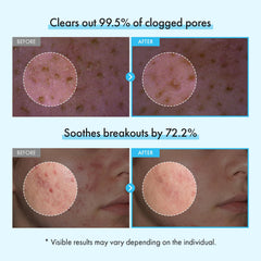 TOSOWOONG micro capsules adhering to pores to lift impurities