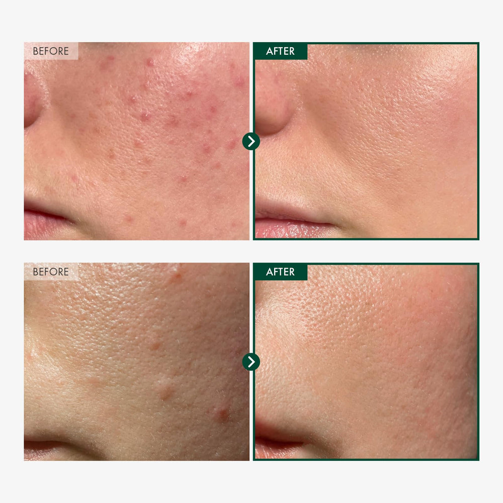 TOSOWOONG Centella ampoule being applied on skin for quick soothing use