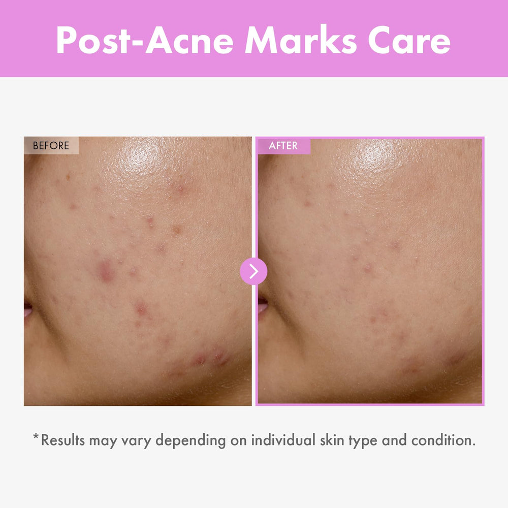 TOSOWOONG Niacinamide Hyaluronic Acid Serum on skin surface with hydration