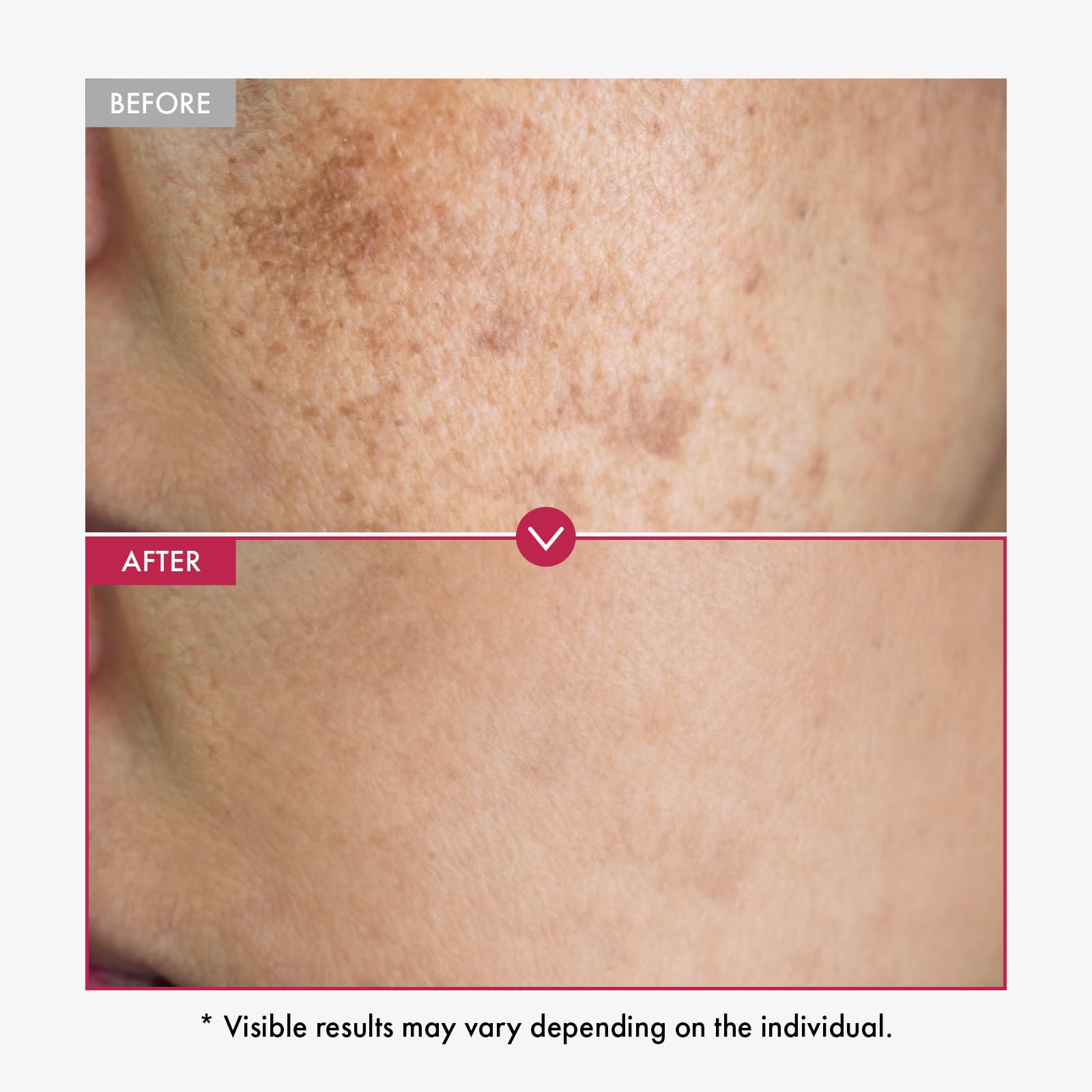 TOSOWOONG Niacinamide, Tranexamic Acid, Arbutin trio clarifies uneven tone.