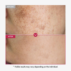 TOSOWOONG Niacinamide, Tranexamic Acid, Arbutin trio clarifies uneven tone.