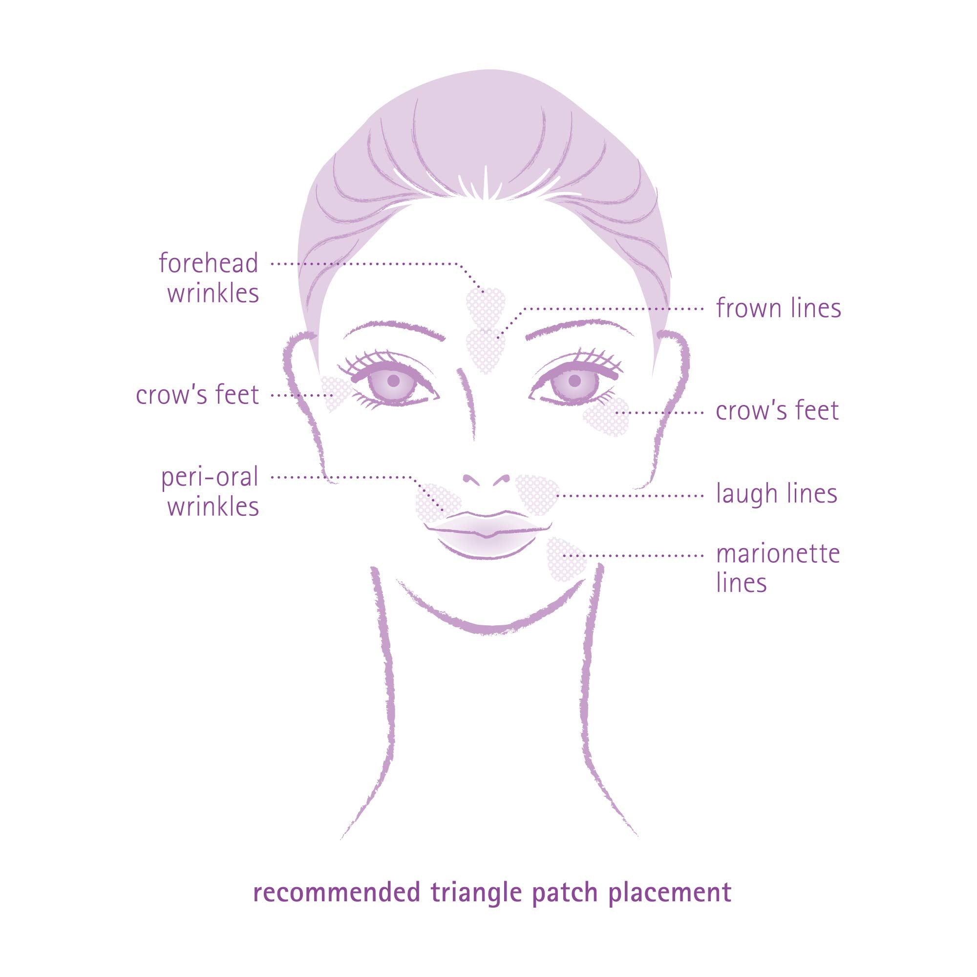 Toute Nuit triangle patches on lip wrinkles may smooth perioral lines for a subtle appearance.