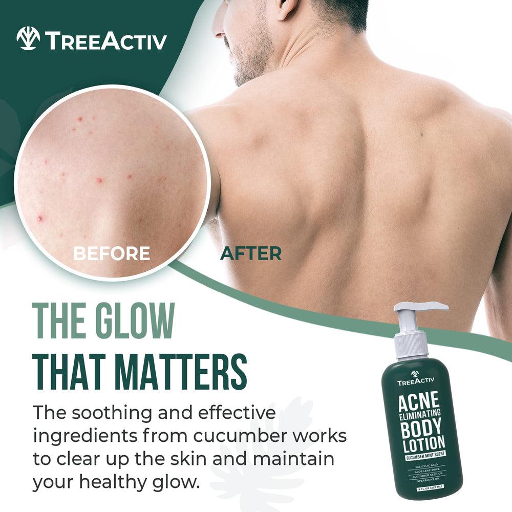 TreeActiv Acne Eliminating Body Lotion back view shows lightweight, fast-absorbing formula.