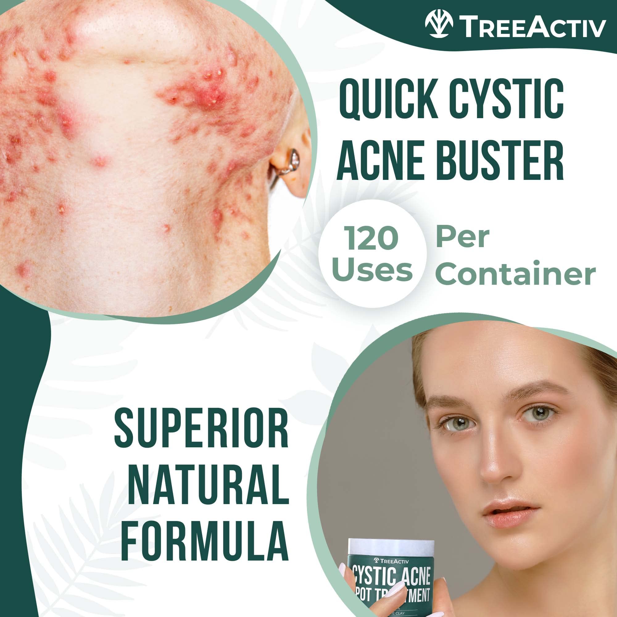 TreeActiv cystic acne spot treatment ingredients bentonite clay highlighted for cleansing.