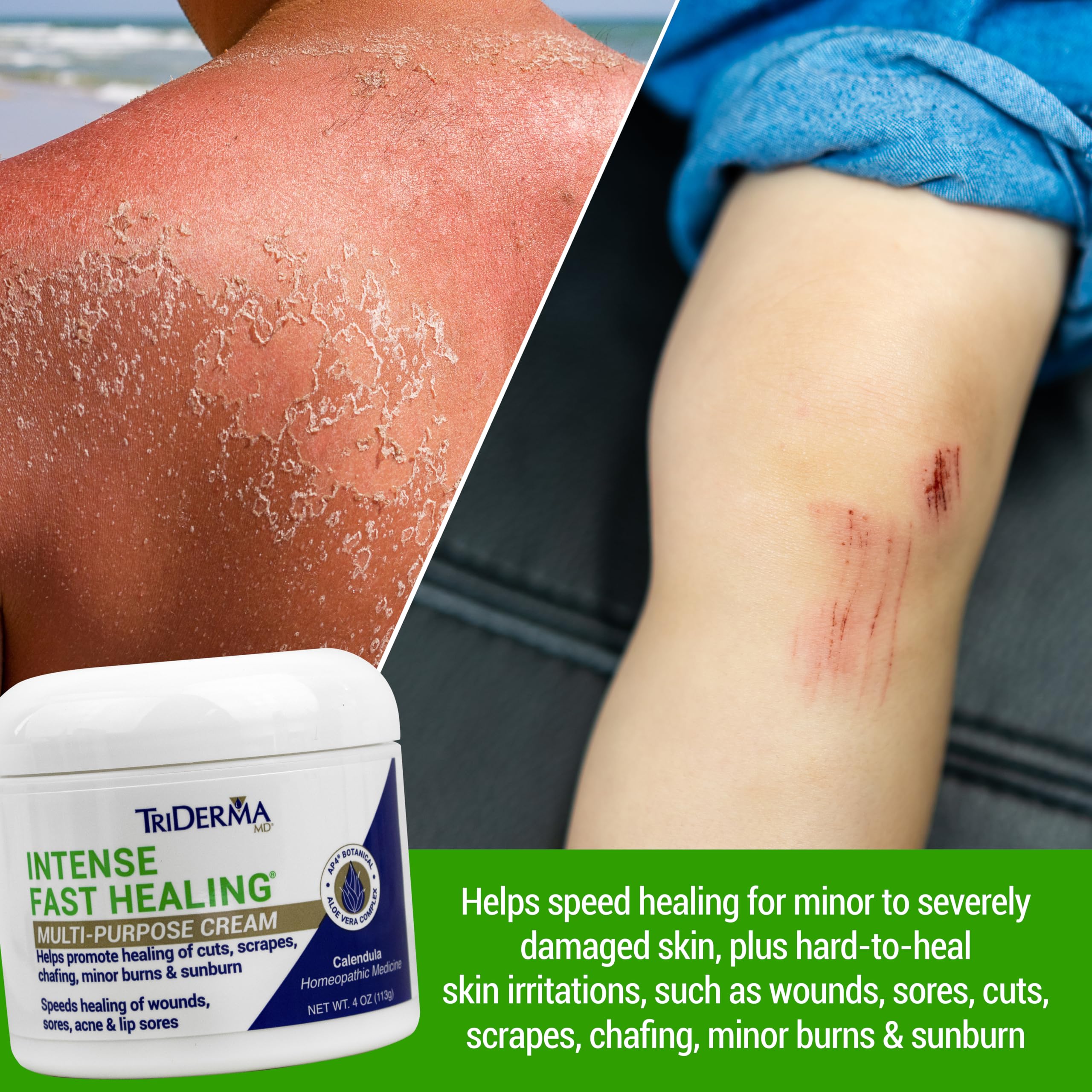 TriDerma Intense Fast Healing Cream AP4 Aloe Complex illustration highlights soothing skin support