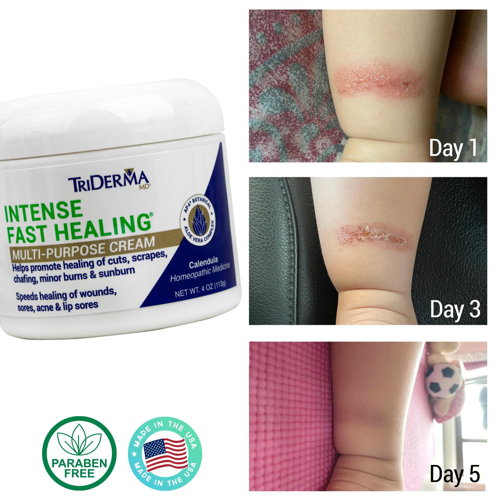 TriDerma Intense Fast Healing Cream face application showing gentle use on sensitive skin