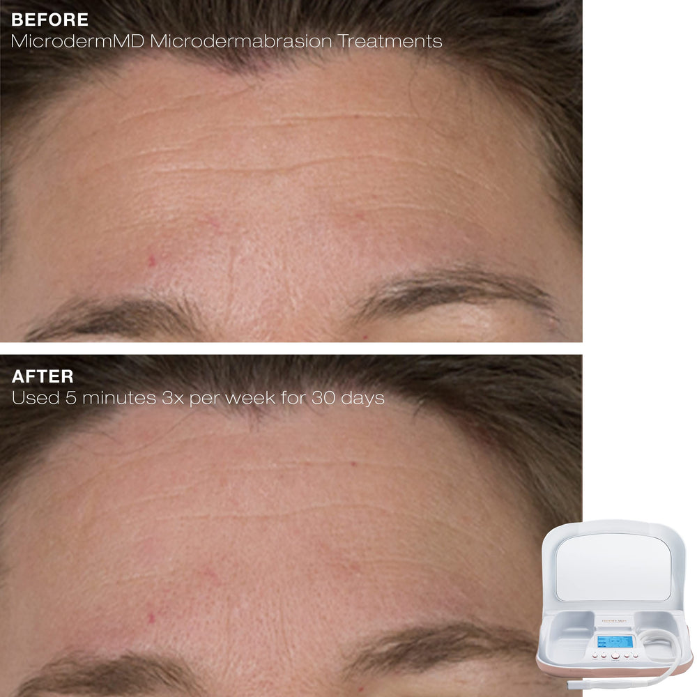 Trophy Skin MicrodermMD close-up shows effect on skin tone and texture.