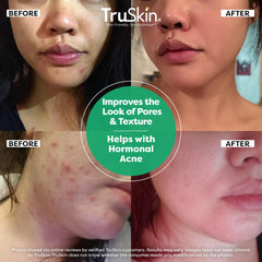 TruSkin ingredients vial image hints at key actives like salicylic acid