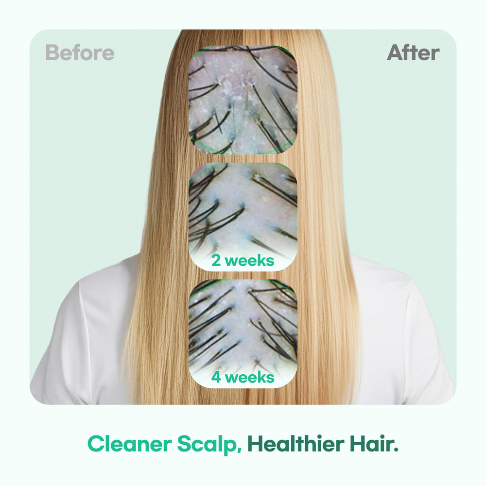 TS GD Shampoo targets flaky-prone teen scalps for calmer, healthier-feeling skin.