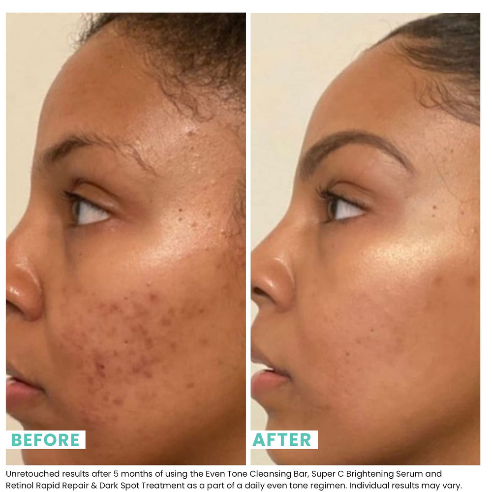 Urban Skin Rx Even Tone cleansing bar lather forming for 1-2 minute treatment.
