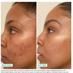 Urban Skin Rx Even Tone cleansing bar lather forming for 1-2 minute treatment.