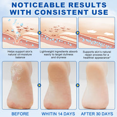 Urea foot cream smoothing image showing improved skin texture