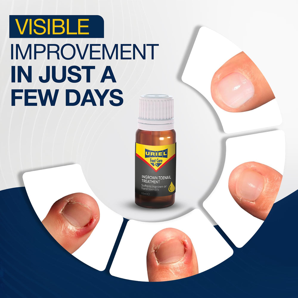 URIEL UPGRADED ingrown toenail-drops application for easy at-home relief