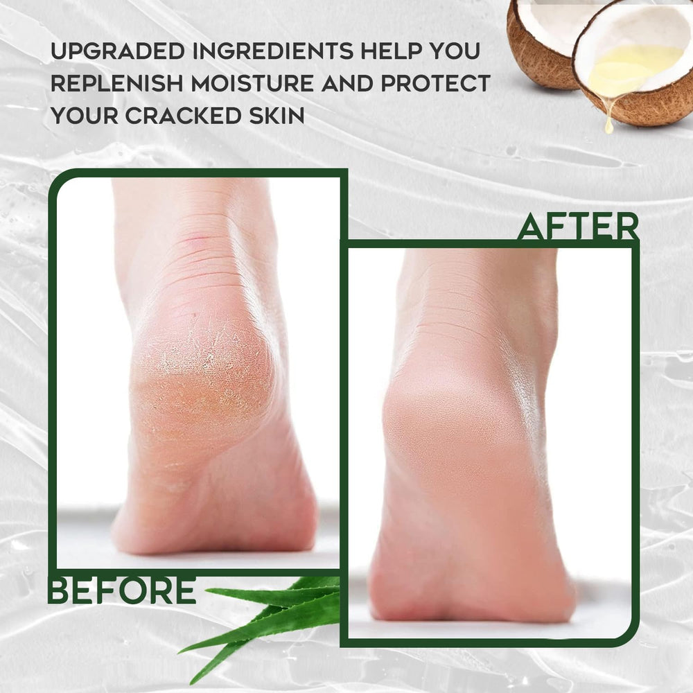 Vebuni Urea Cream elbows and knees application targets thickened skin.