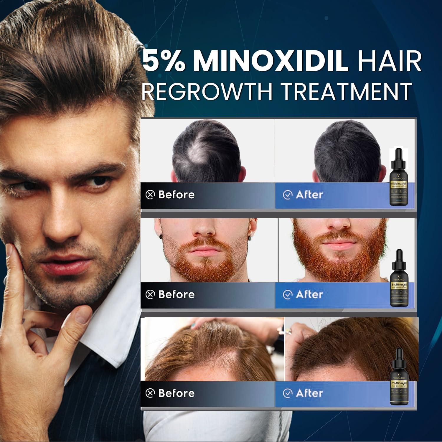 Venanoci Minoxidil dropper enables precise scalp application.