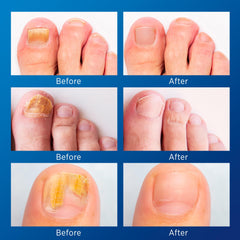 VigorWell 32 Nail Repair Patches image highlights targeted patch repair for toenails