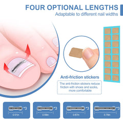 VITASY titanium alloy corrector demonstrates durable support for curved nails.