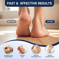VREKEF Urea Cream on foot heel demonstrates deep moisturization for dry skin.