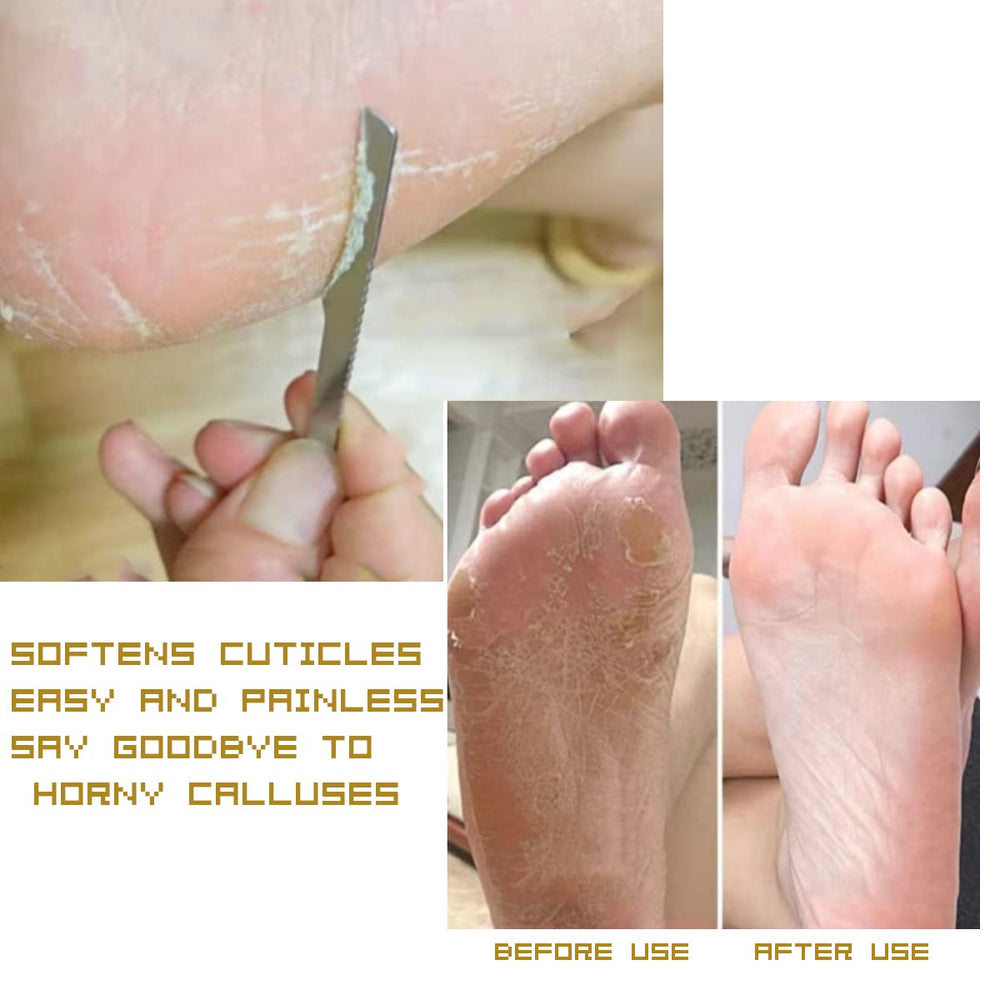 WANLIAN oblique knife targets nail grooves and minor ingrown areas