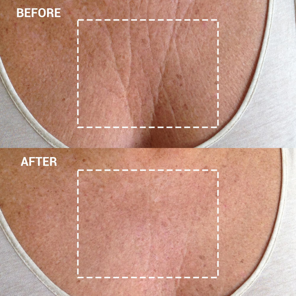 Wrinkles Schminkles Silicone Patch reusable closeup for overnight smoothing